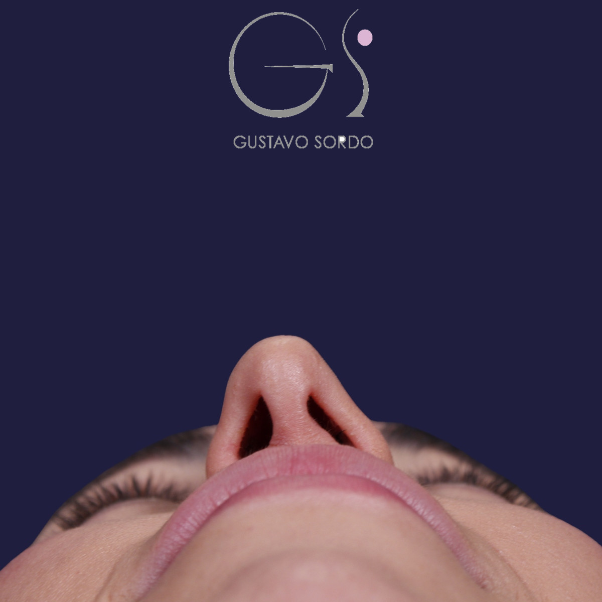 Rhinoplastie ultrasonique réalisée sur un patient — avant l'intervention. Cas opéré par le Dr Gustavo Sordo à Madrid
