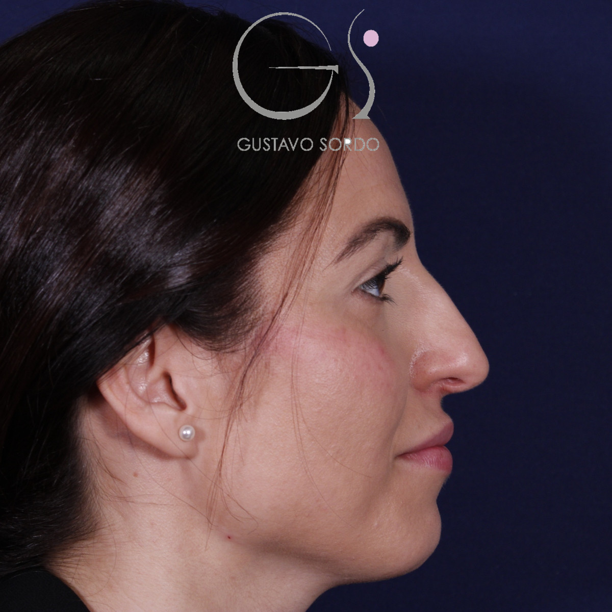 Rhinoplastie ultrasonique réalisée sur un patient — avant l'intervention. Cas opéré par le Dr Gustavo Sordo à Madrid
