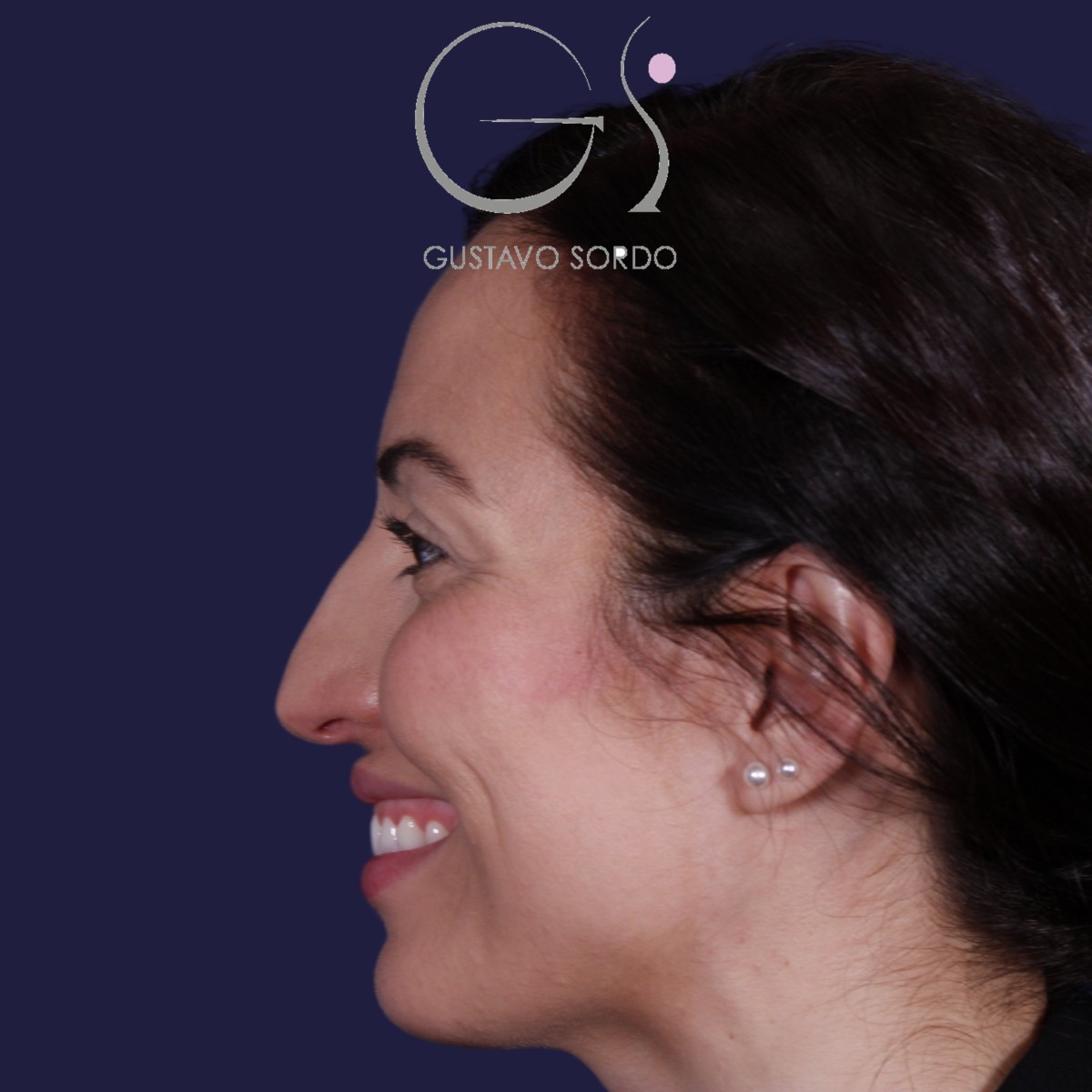 Rhinoplastie ultrasonique réalisée sur un patient — avant l'intervention. Cas opéré par le Dr Gustavo Sordo à Madrid