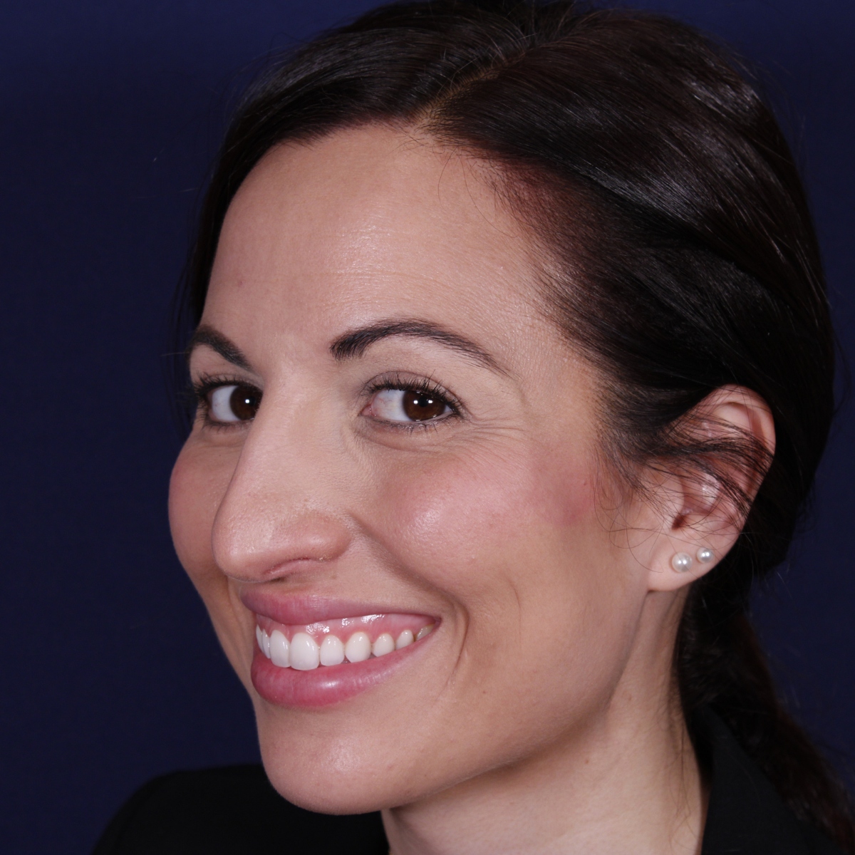 Rhinoplastie ultrasonique réalisée sur un patient — avant l'intervention. Cas opéré par le Dr Gustavo Sordo à Madrid