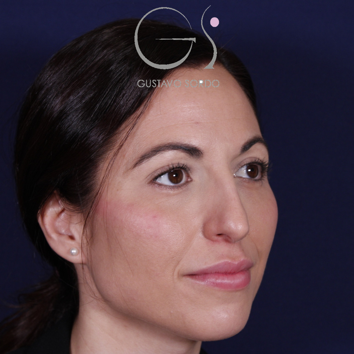 Rhinoplastie ultrasonique réalisée sur un patient — avant l'intervention. Cas opéré par le Dr Gustavo Sordo à Madrid
