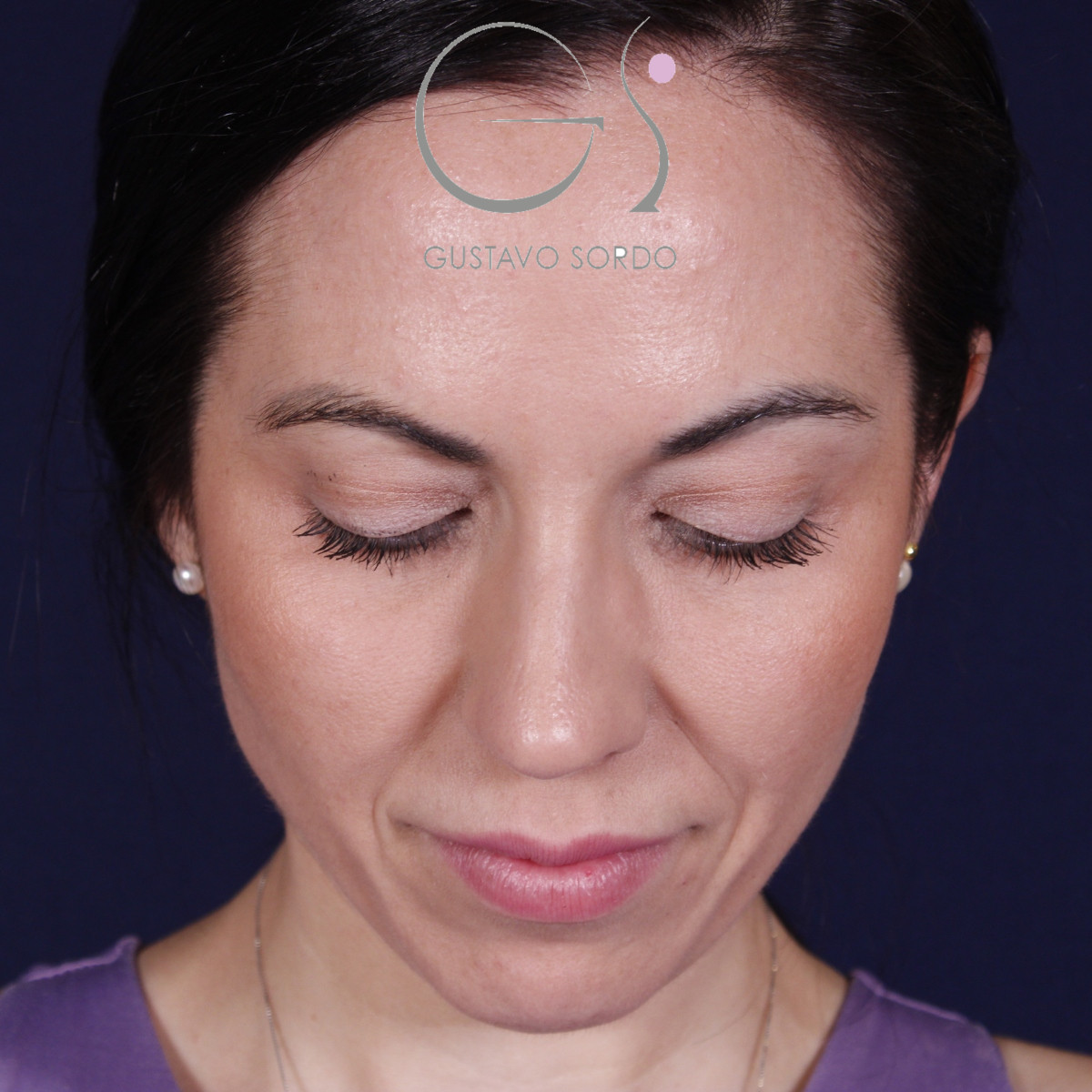 Rhinoplastie ultrasonique réalisée sur un patient – résultat. Intervention réalisée par le Dr Gustavo Sordo à Madrid.