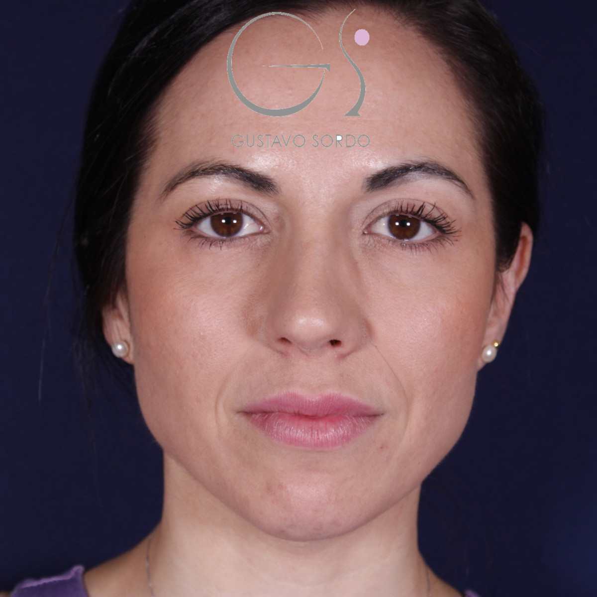Rhinoplastie ultrasonique réalisée sur un patient – résultat. Intervention réalisée par le Dr Gustavo Sordo à Madrid.