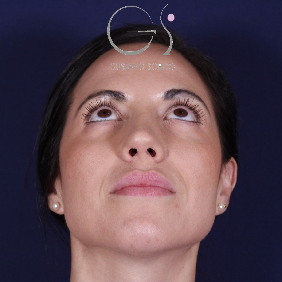Rhinoplastie ultrasonique réalisée sur un patient – résultat. Intervention réalisée par le Dr Gustavo Sordo à Madrid.