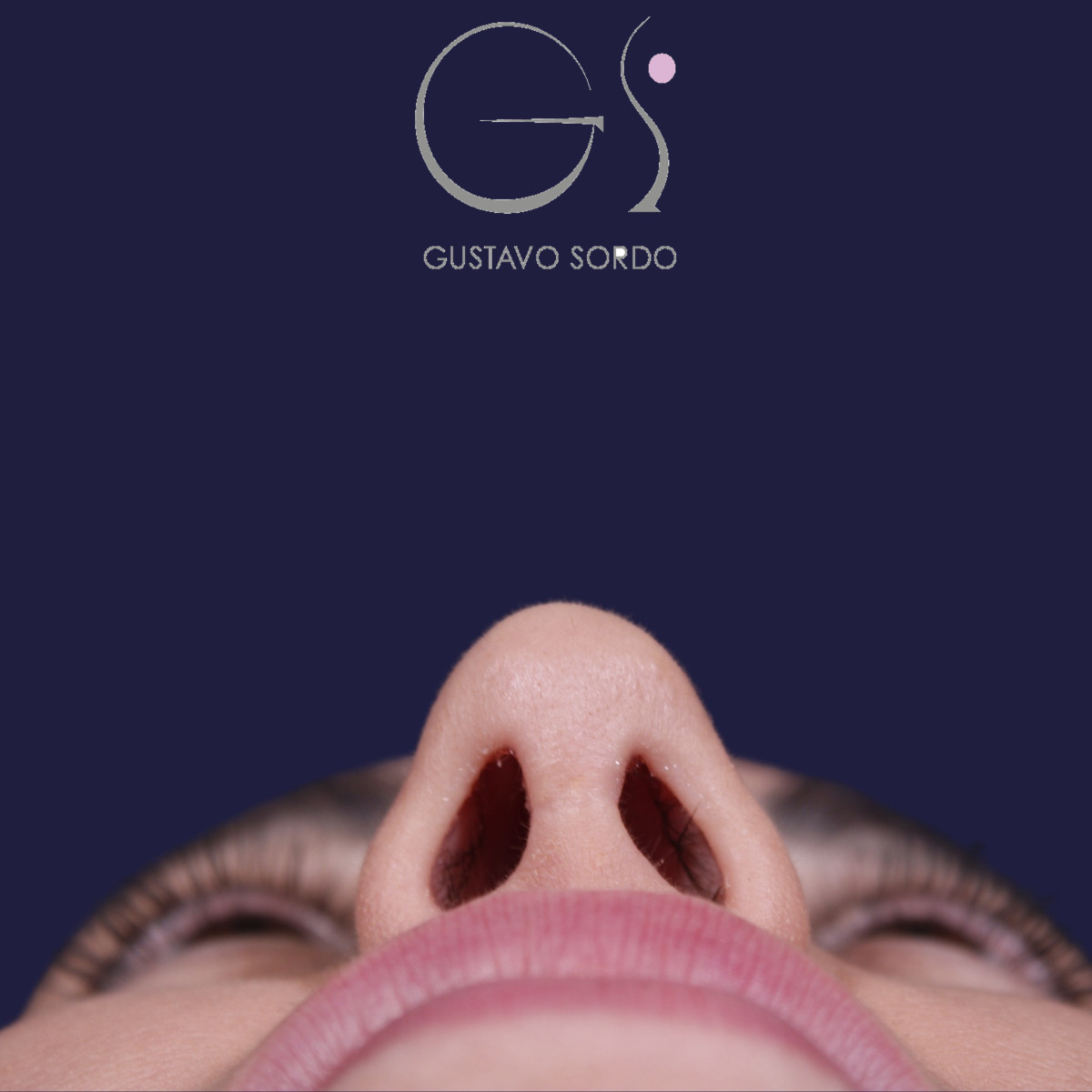 Rhinoplastie ultrasonique réalisée sur un patient – résultat. Intervention réalisée par le Dr Gustavo Sordo à Madrid.