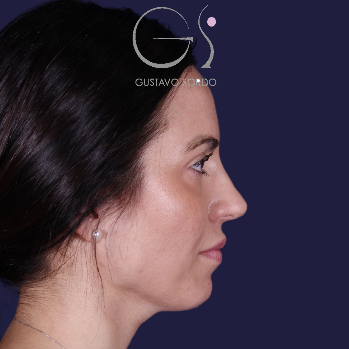 Rhinoplastie ultrasonique réalisée sur un patient – résultat. Intervention réalisée par le Dr Gustavo Sordo à Madrid.