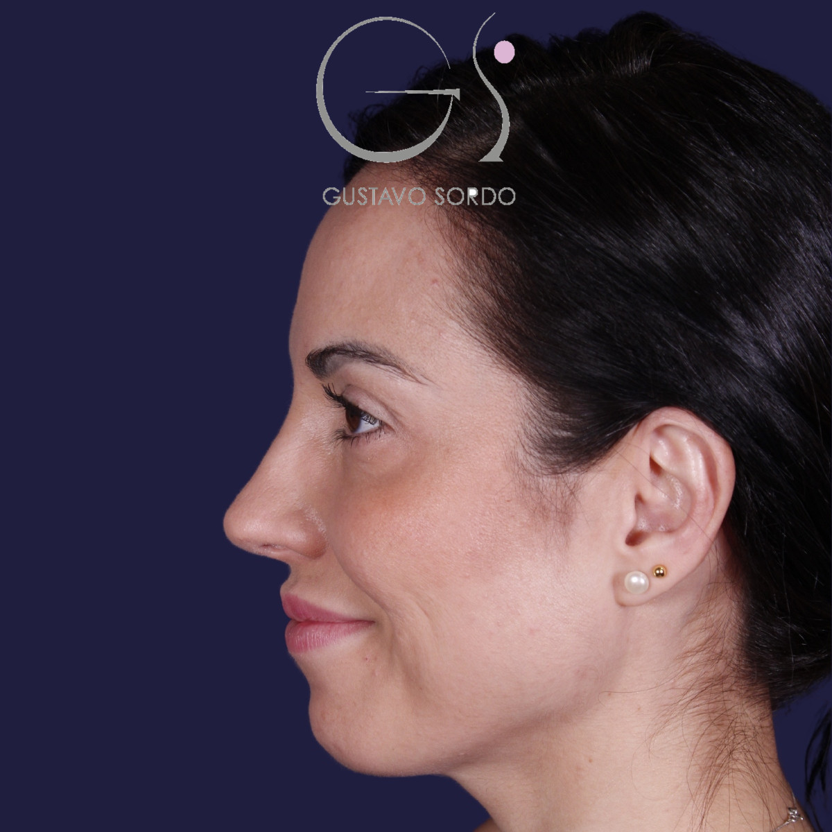 Rhinoplastie ultrasonique réalisée sur un patient – résultat. Intervention réalisée par le Dr Gustavo Sordo à Madrid.