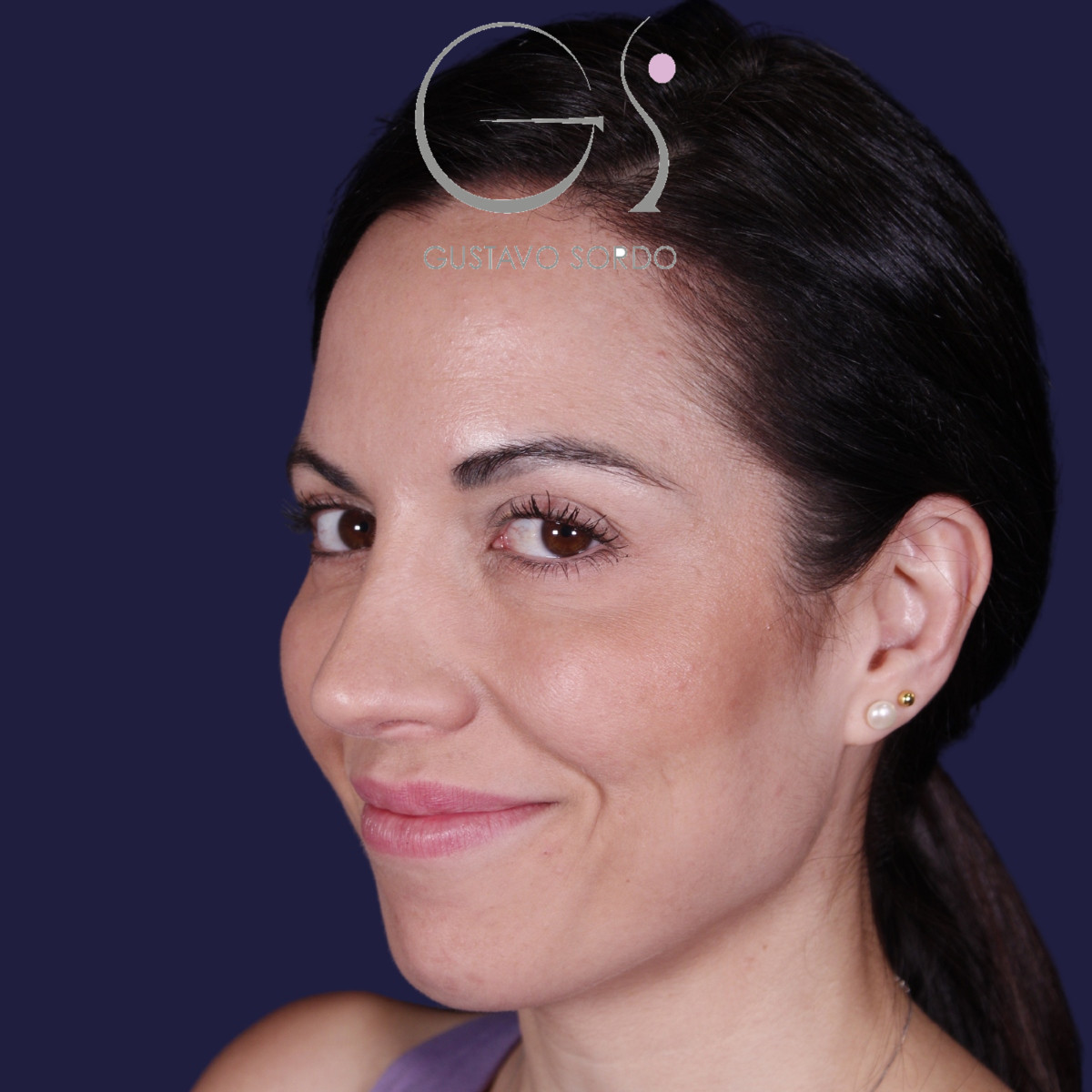 Rhinoplastie ultrasonique réalisée sur un patient – résultat. Intervention réalisée par le Dr Gustavo Sordo à Madrid.