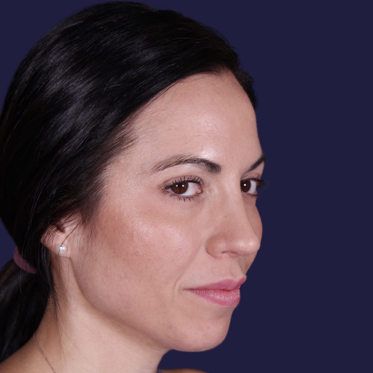 Rhinoplastie ultrasonique réalisée sur un patient – résultat. Intervention réalisée par le Dr Gustavo Sordo à Madrid.