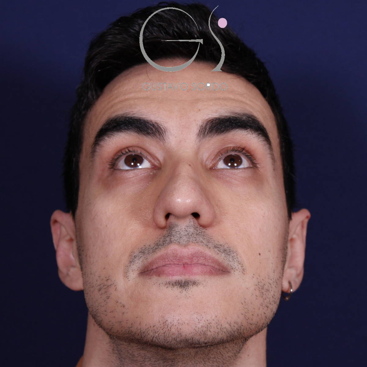 Rinoplastia ultrasónica en hombre con piel gruesa, antes de la operación (3)