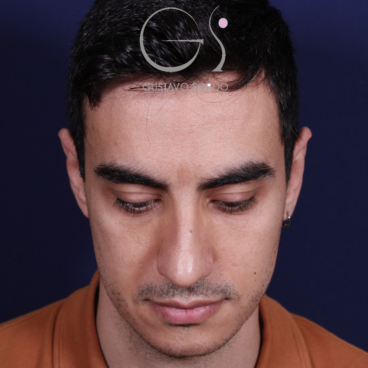 Rinoplastia ultrasónica en hombre con piel gruesa, antes de la operación (2)