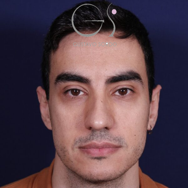 Rinoplastia ultrasónica en hombre con piel gruesa, antes de la operación (1)