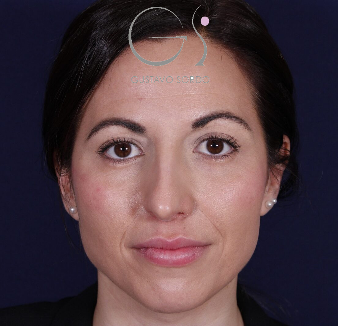 Rhinoplastie ultrasonique réalisée sur un patient — avant l'intervention. Cas opéré par le Dr Gustavo Sordo à Madrid