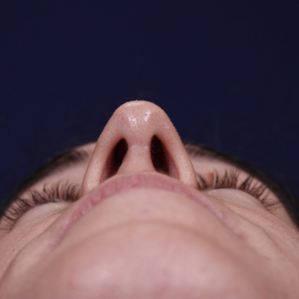 Rinoplastia, resultado tras la cirugía — caso operado por el Dr. Gustavo Sordo en Madrid (4)