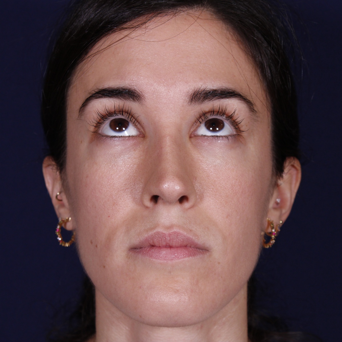 Rinoplastia, resultado tras la cirugía — caso operado por el Dr. Gustavo Sordo en Madrid (2)
