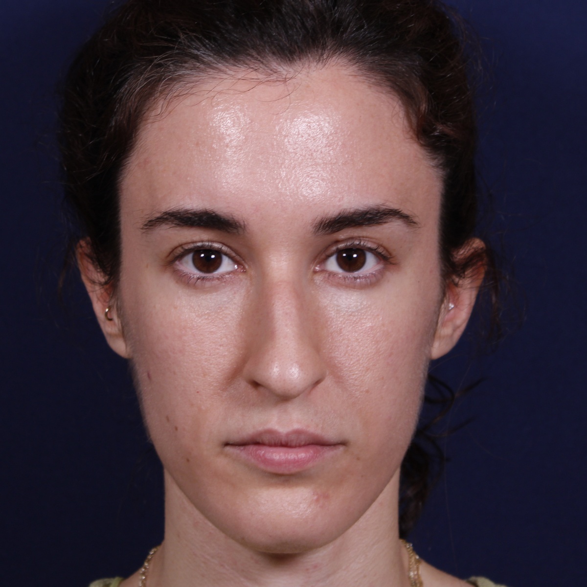 Rinoplastia, antes de la cirugía — caso operado por el Dr. Gustavo Sordo en Madrid (1)