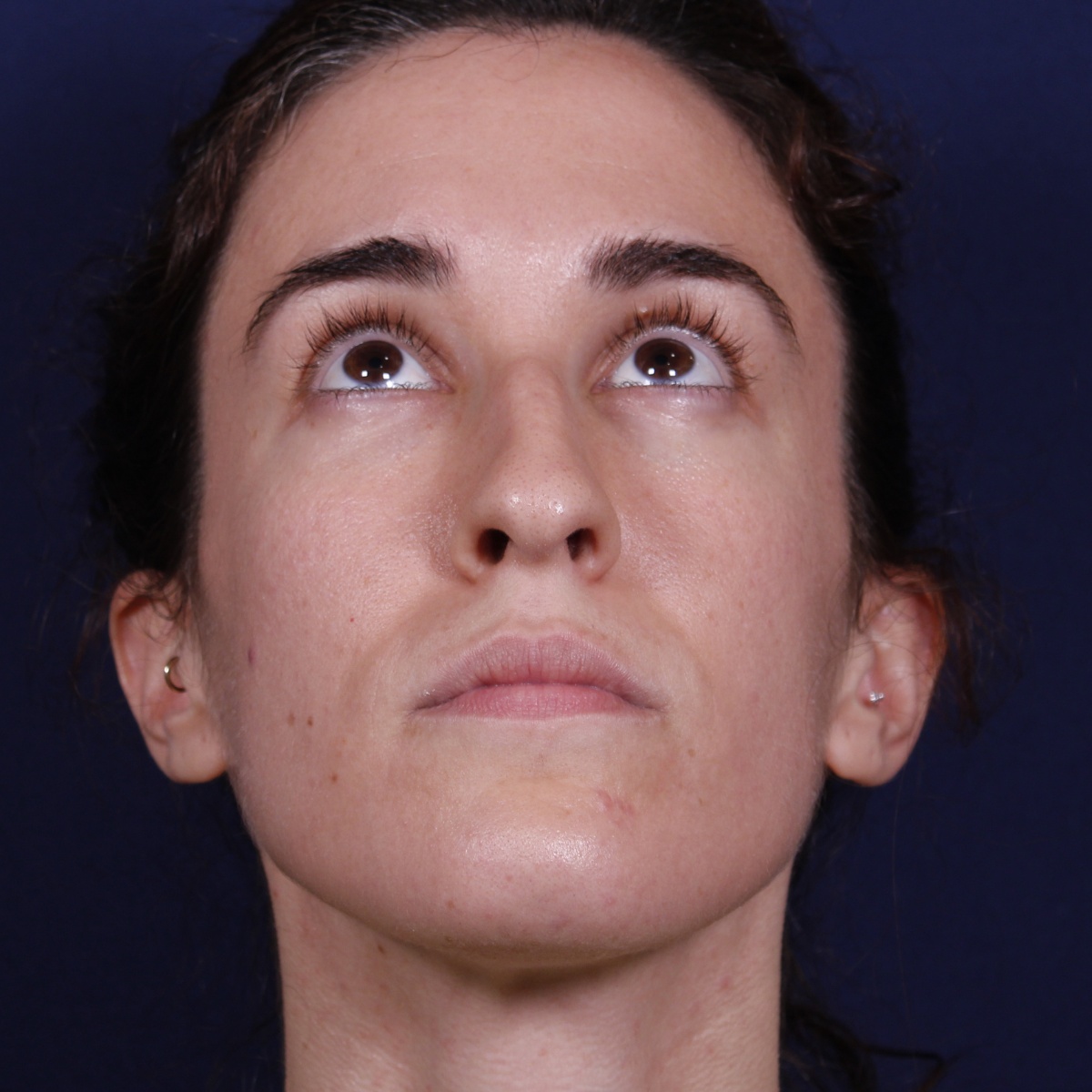 Rinoplastia, antes de la cirugía — caso operado por el Dr. Gustavo Sordo en Madrid (2)