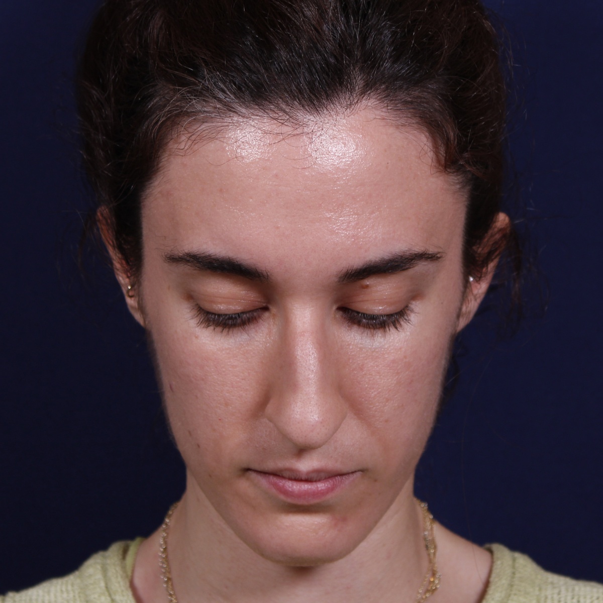 Rinoplastia, antes de la cirugía — caso operado por el Dr. Gustavo Sordo en Madrid (3)