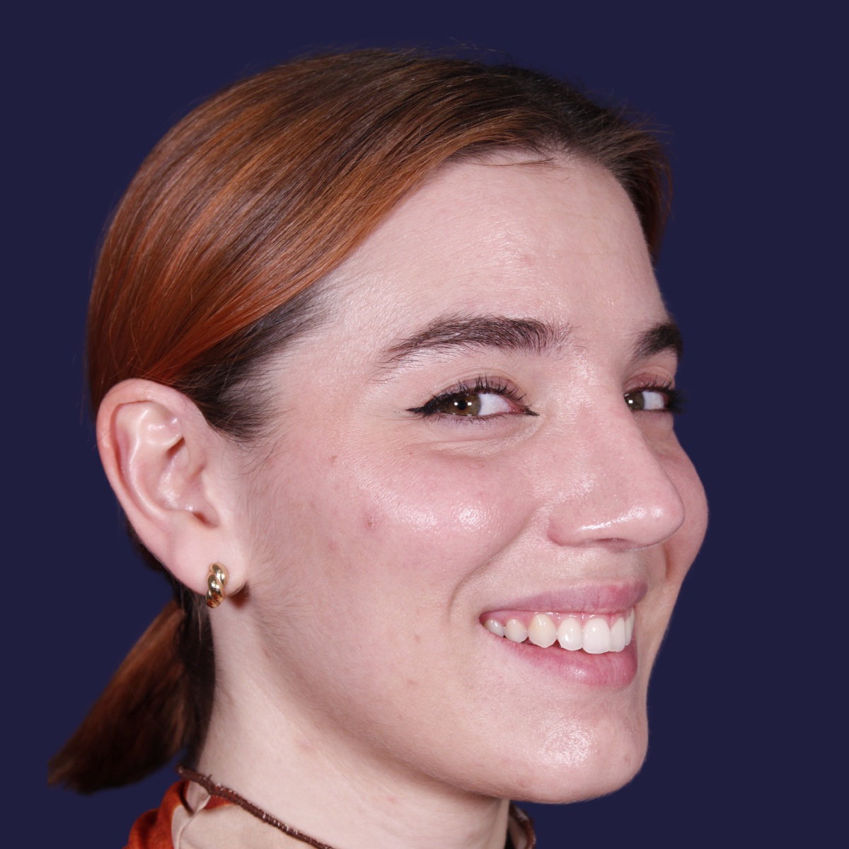 Rinoplastia, resultado tras la cirugía — caso operado por el Dr. Gustavo Sordo en Madrid (6)
