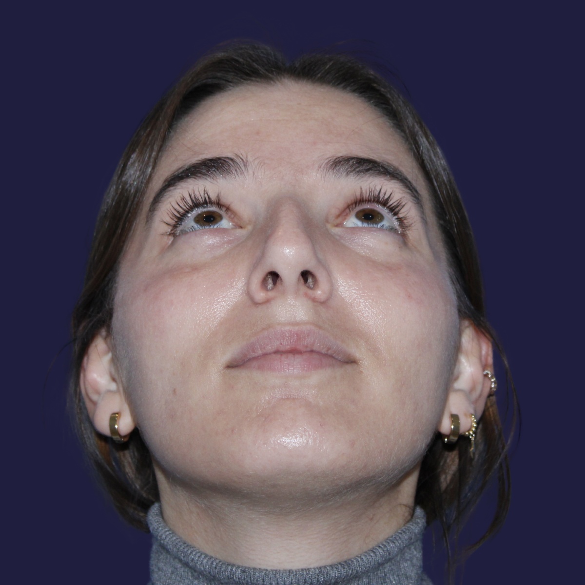 Rinoplastia, antes de la cirugía — caso operado por el Dr. Gustavo Sordo en Madrid (3)