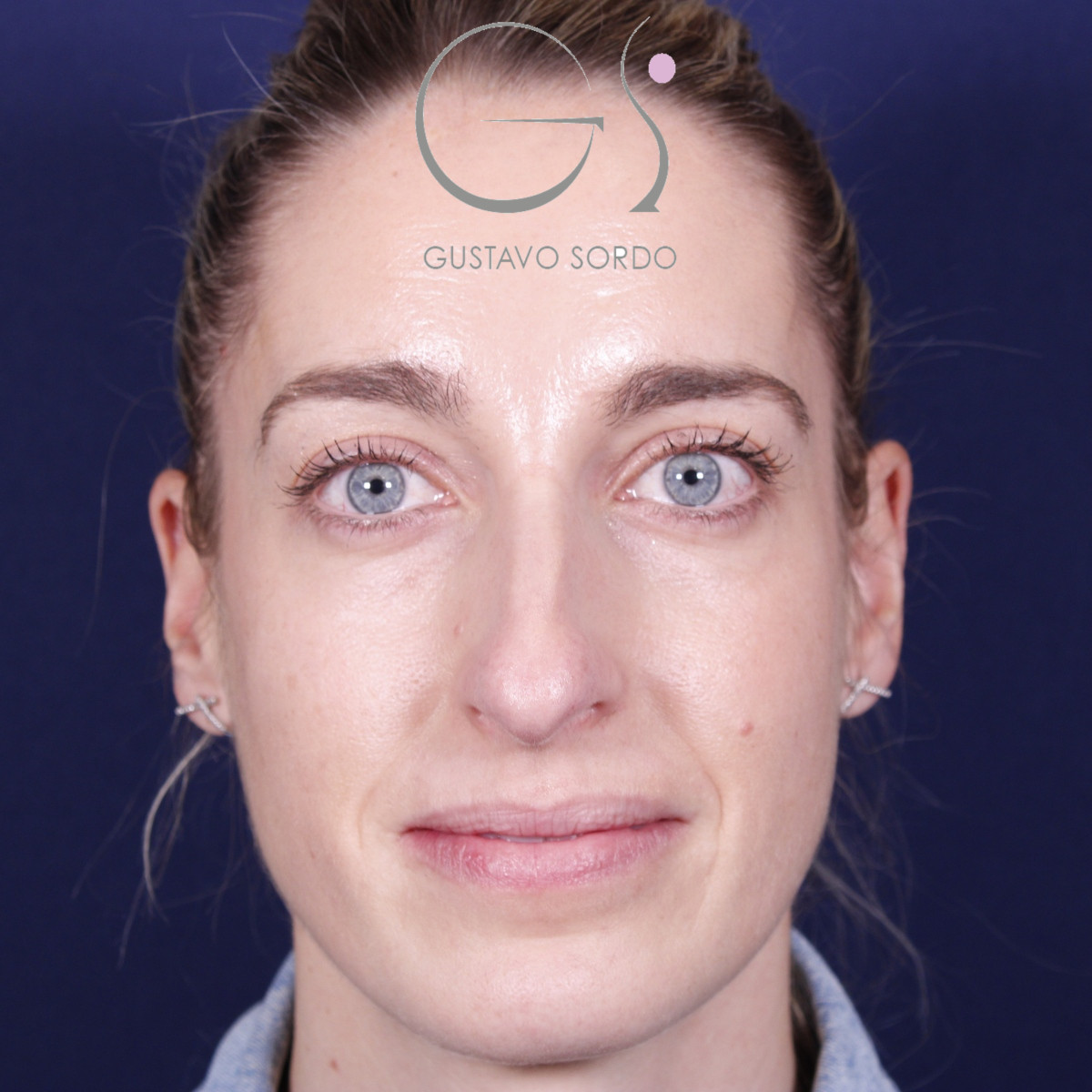 Rinoplastia ultrasónica en mujer con nariz aguileña y larga, antes de la operación (1)