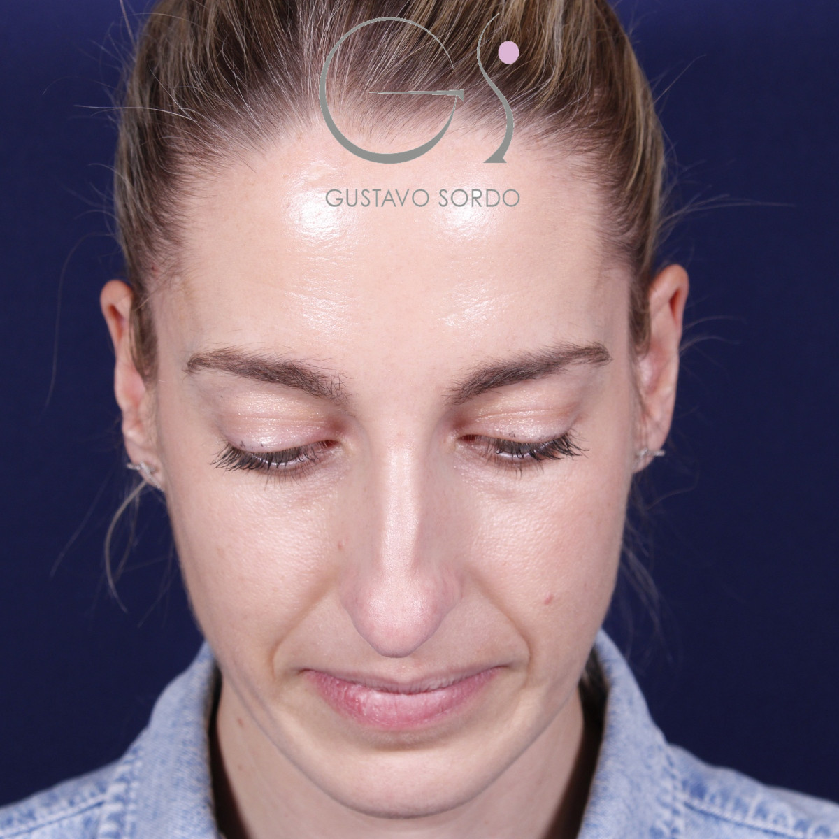 Rinoplastia ultrasónica en mujer con nariz aguileña y larga, antes de la operación (2)