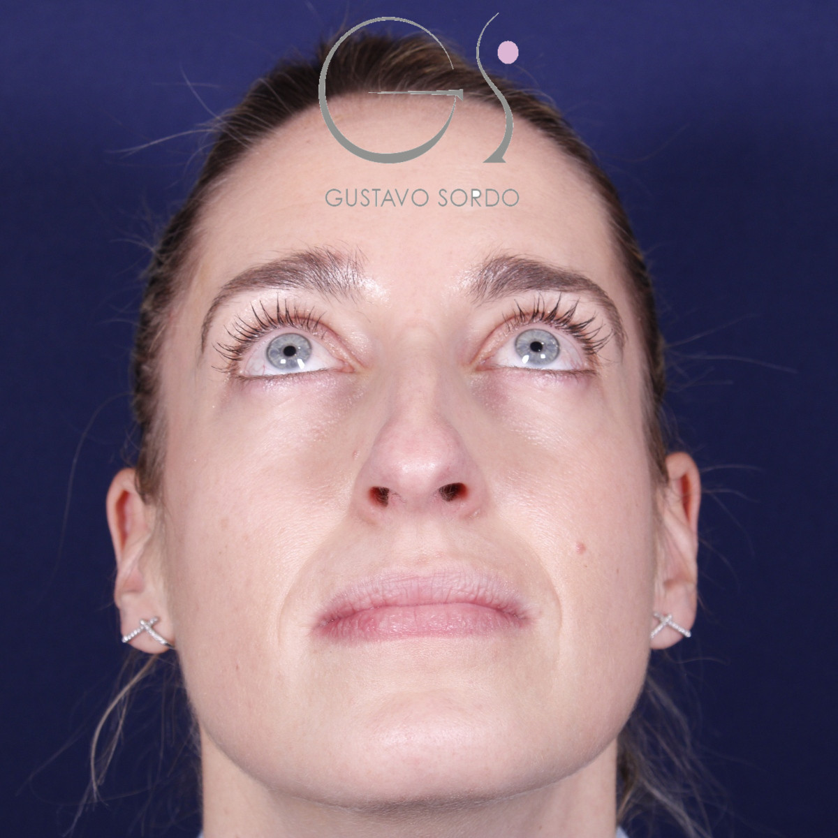 Rinoplastia ultrasónica en mujer con nariz aguileña y larga, antes de la operación (3)