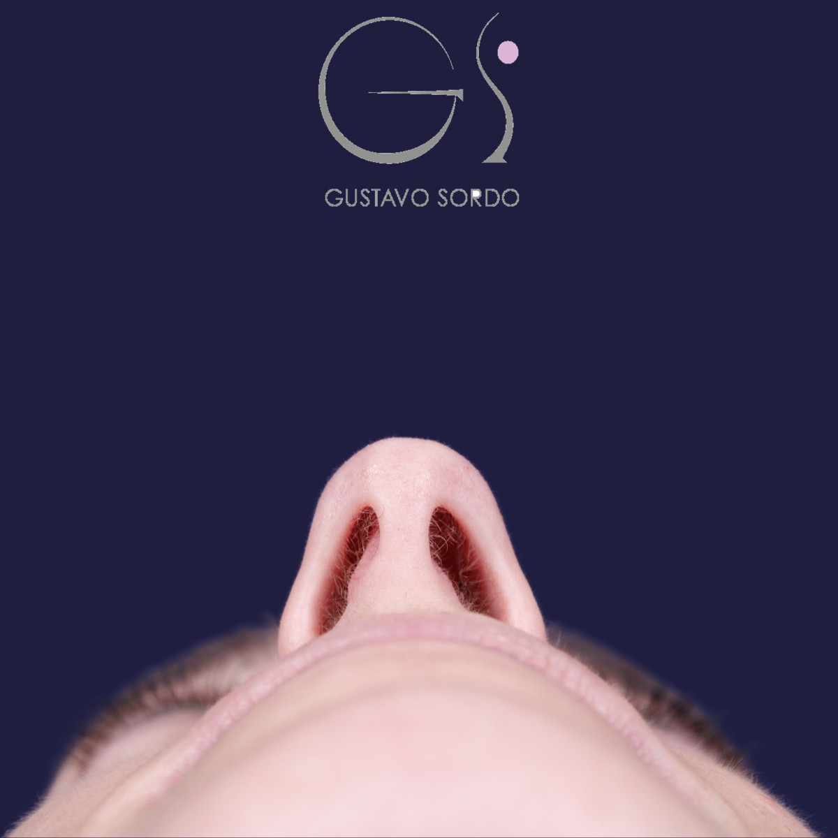 Rinoplastia ultrasónica en mujer con nariz aguileña y larga, antes de la operación (4)