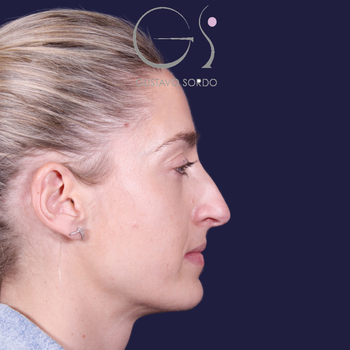 Rinoplastia ultrasónica en mujer con nariz aguileña y larga, antes de la operación (5)