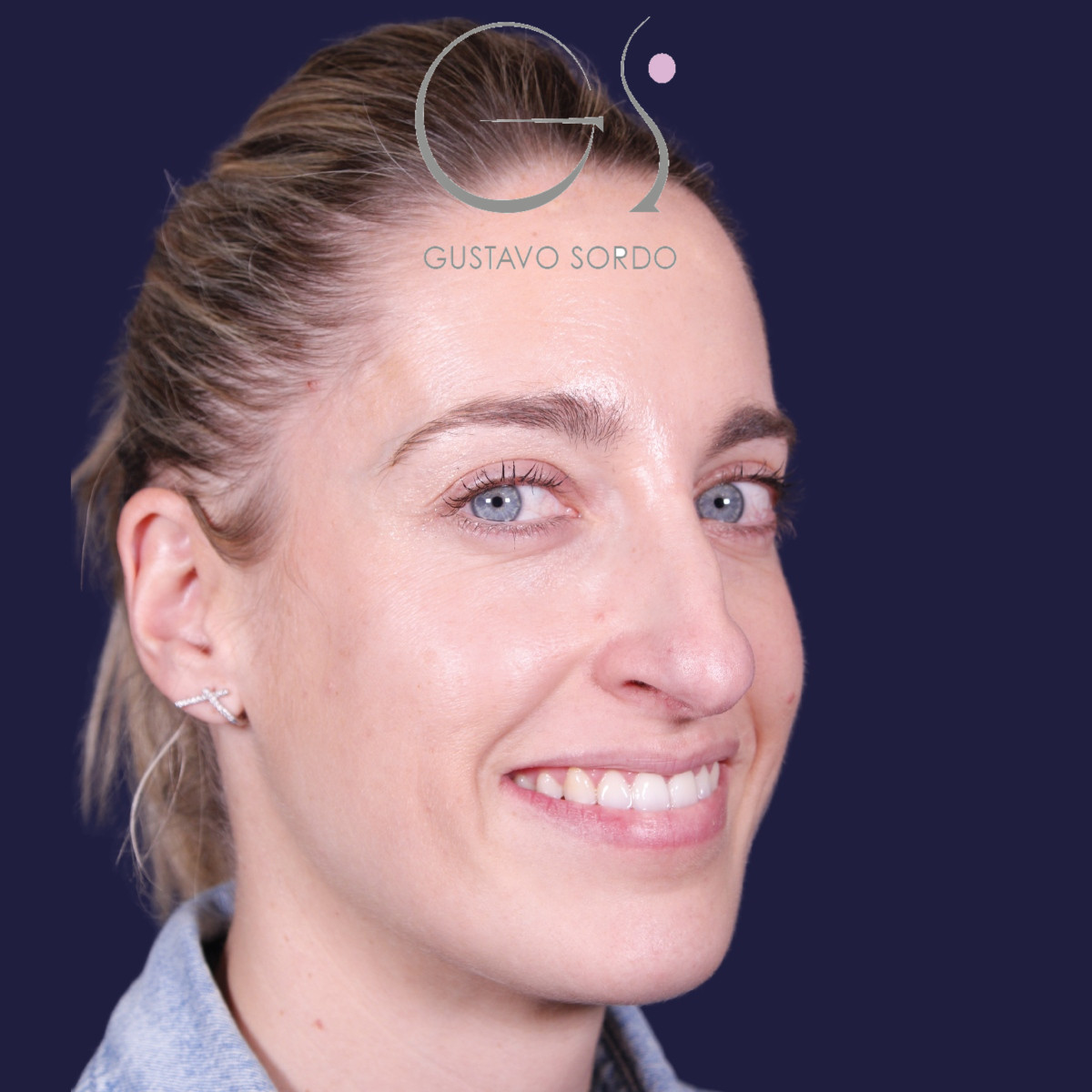 Rinoplastia ultrasónica en mujer con nariz aguileña y larga, antes de la operación (6)