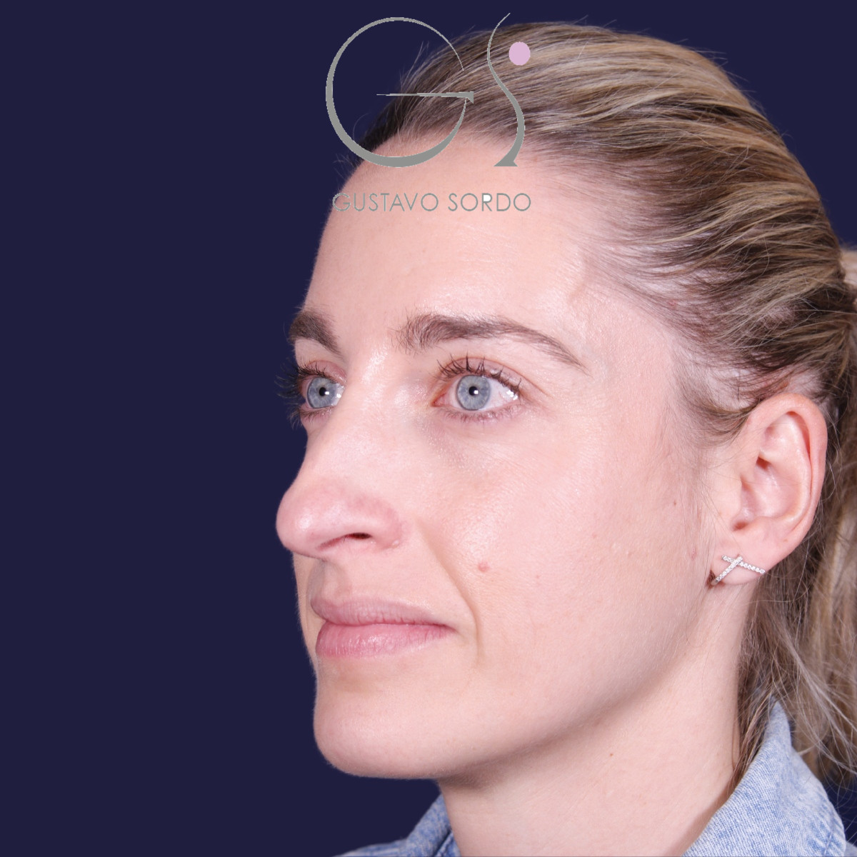 Rinoplastia ultrasónica en mujer con nariz aguileña y larga, antes de la operación (7)