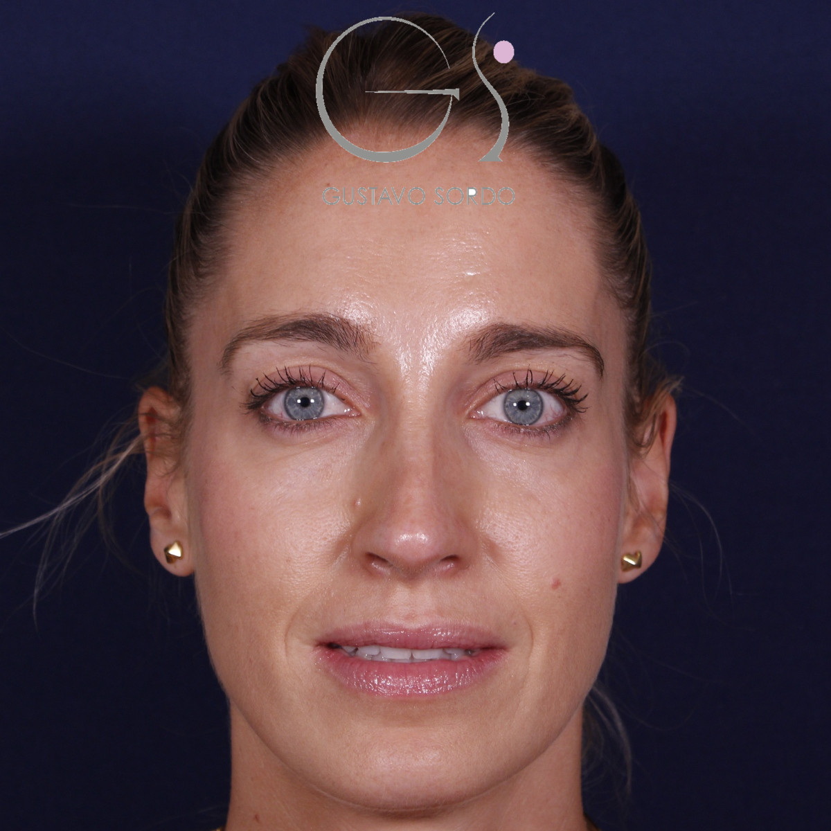 Rinoplastia ultrasónica en mujer con nariz aguileña y larga, después de la operación (1)