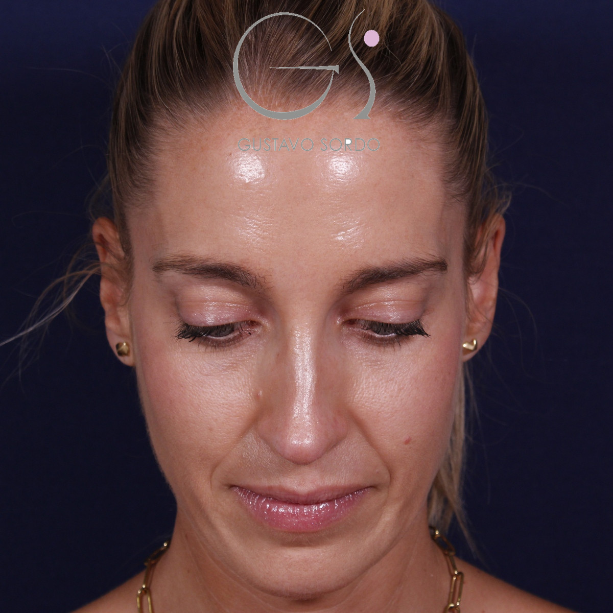 Rinoplastia ultrasónica en mujer con nariz aguileña y larga, después de la operación (2)
