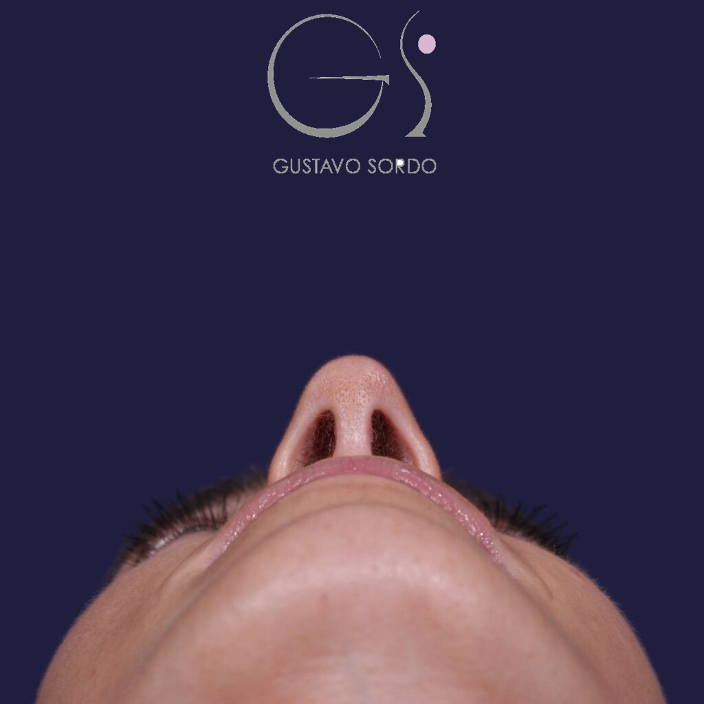 Rinoplastia ultrasónica en mujer con nariz aguileña y larga, después de la operación (4)