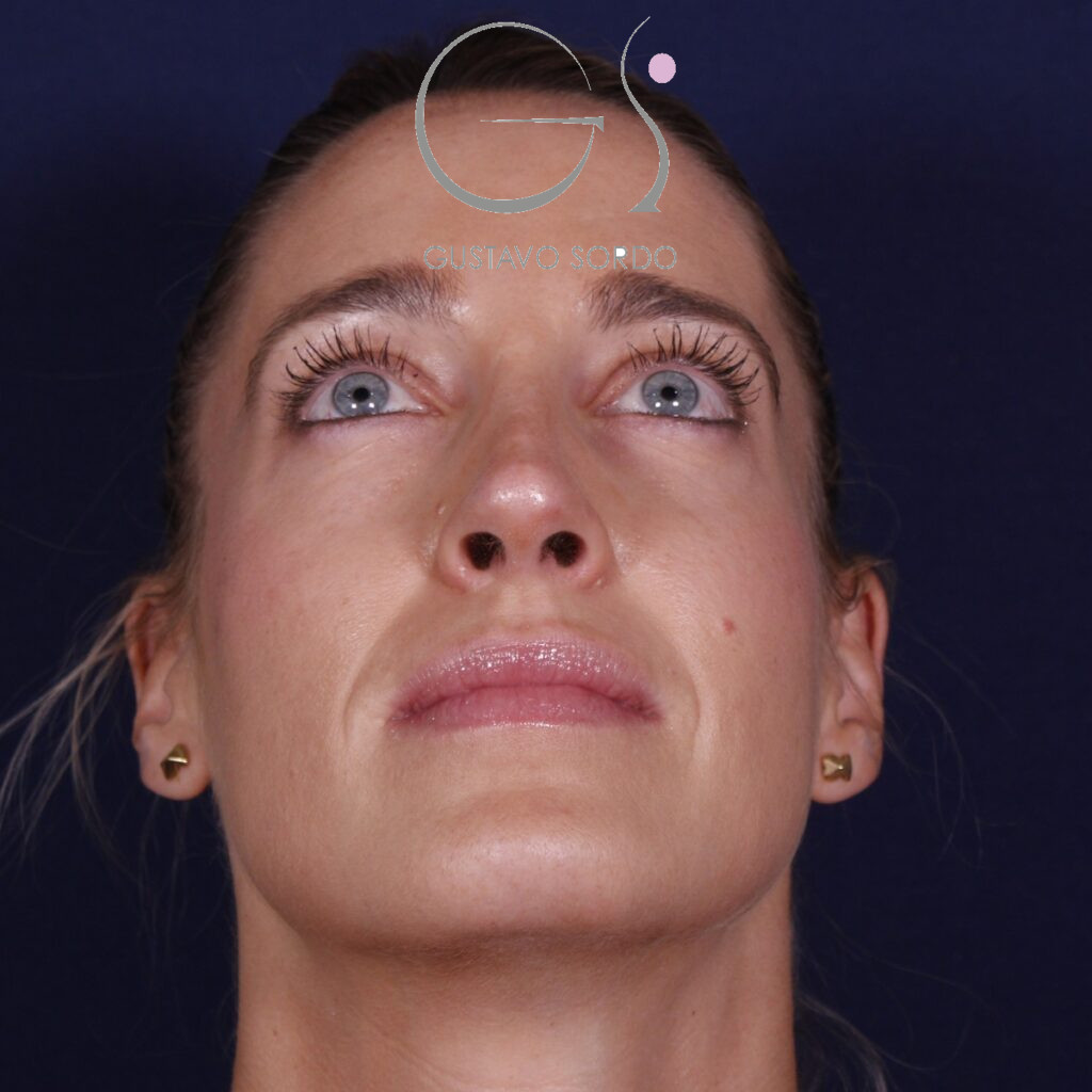 Rinoplastia ultrasónica en mujer con nariz aguileña y larga, después de la operación (3)