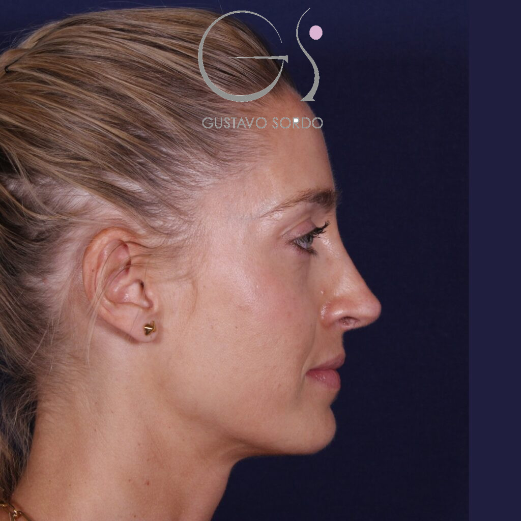 Rinoplastia ultrasónica en mujer con nariz aguileña y larga, después de la operación (5)
