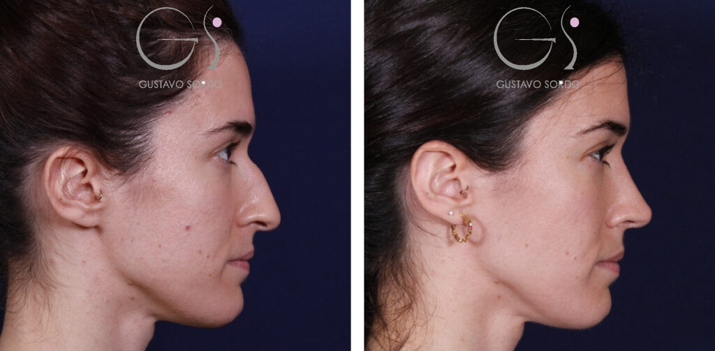 Punta nasal antes y después de rinoplastia ultrasónica — Dr. Gustavo Sordo