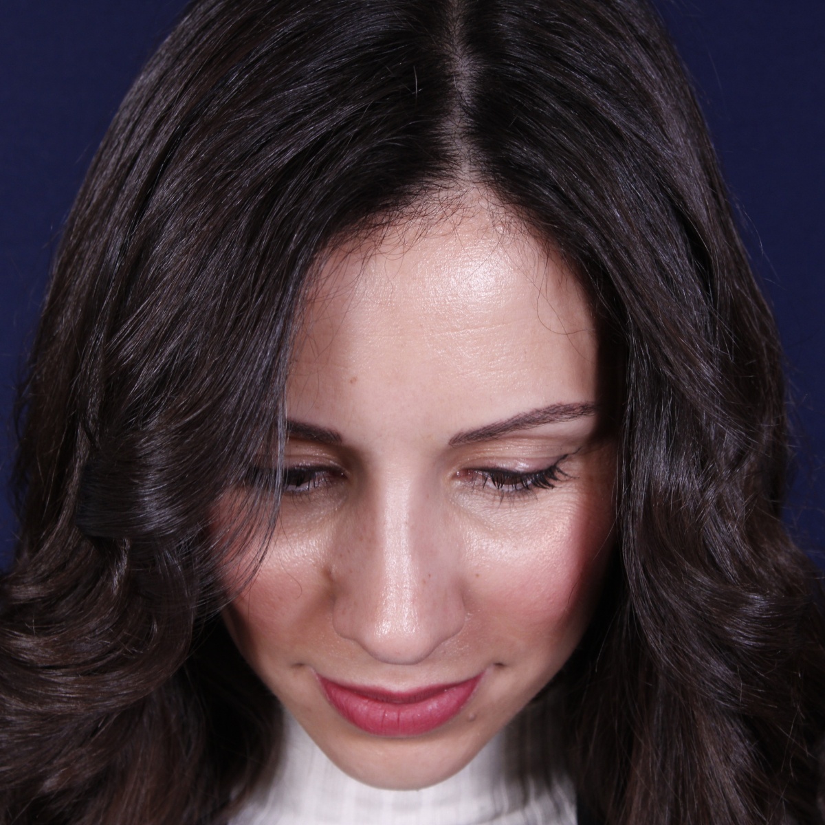 Rhinoplastie ultrasonique, résultat après intervention chirurgicale — cas opéré par le Dr Gustavo Sordo à Madrid (2)