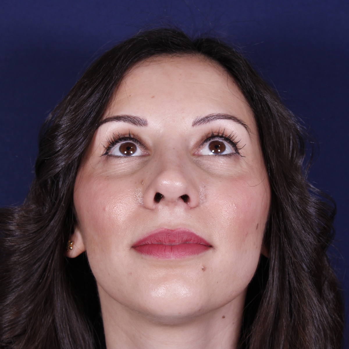 Rhinoplastie ultrasonique, résultat après intervention chirurgicale — cas opéré par le Dr Gustavo Sordo à Madrid (3)