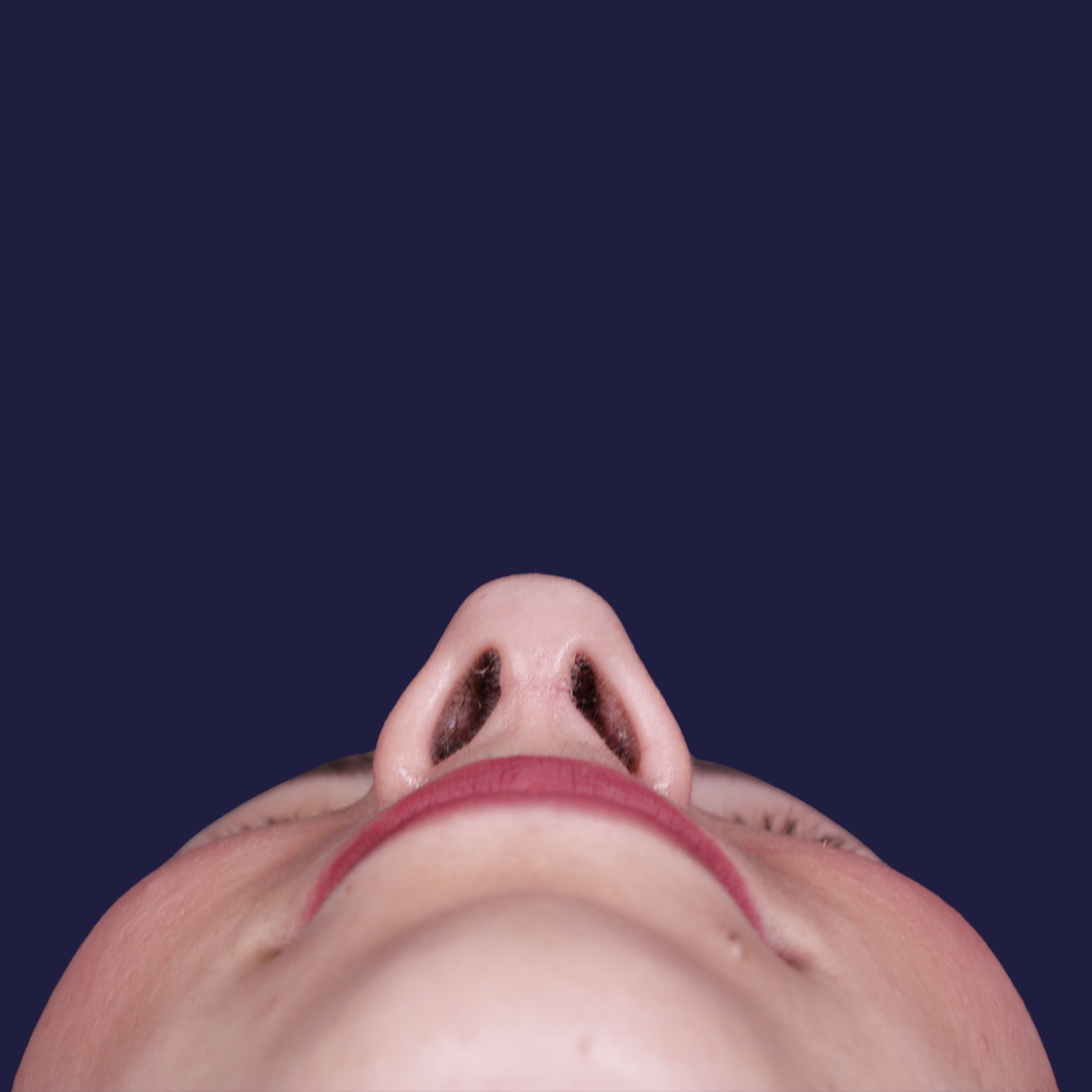 Rhinoplastie ultrasonique, résultat après intervention chirurgicale — cas opéré par le Dr Gustavo Sordo à Madrid (4)