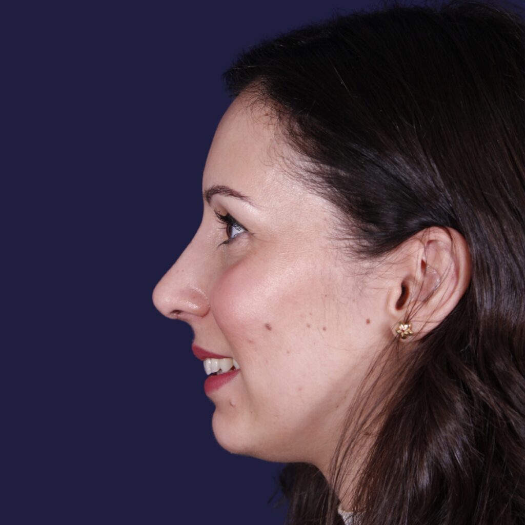 Rhinoplastie ultrasonique, résultat après intervention chirurgicale — cas opéré par le Dr Gustavo Sordo à Madrid (6)