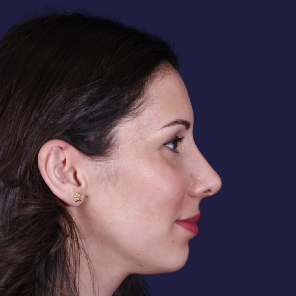 Rhinoplastie ultrasonique, résultat après intervention chirurgicale — cas opéré par le Dr Gustavo Sordo à Madrid (5)