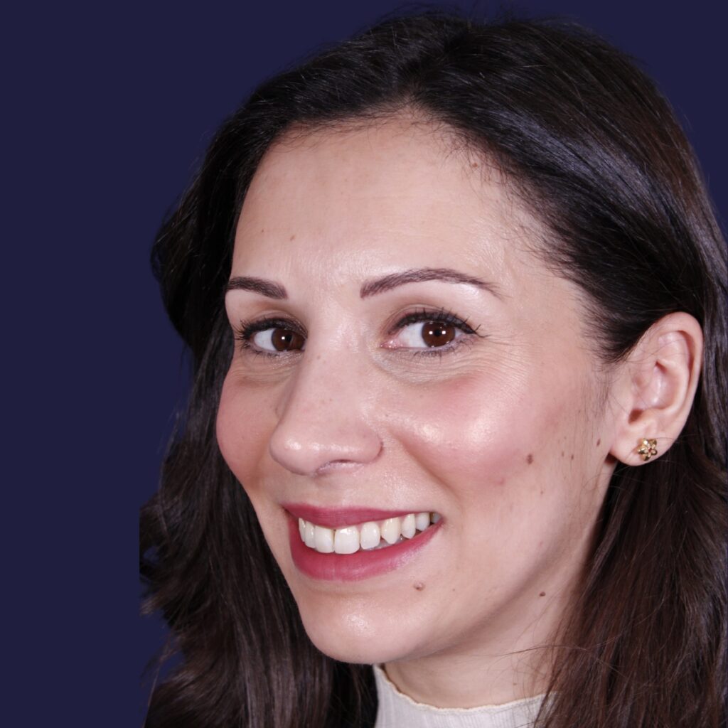 Rhinoplastie ultrasonique, résultat après intervention chirurgicale — cas opéré par le Dr Gustavo Sordo à Madrid (8)