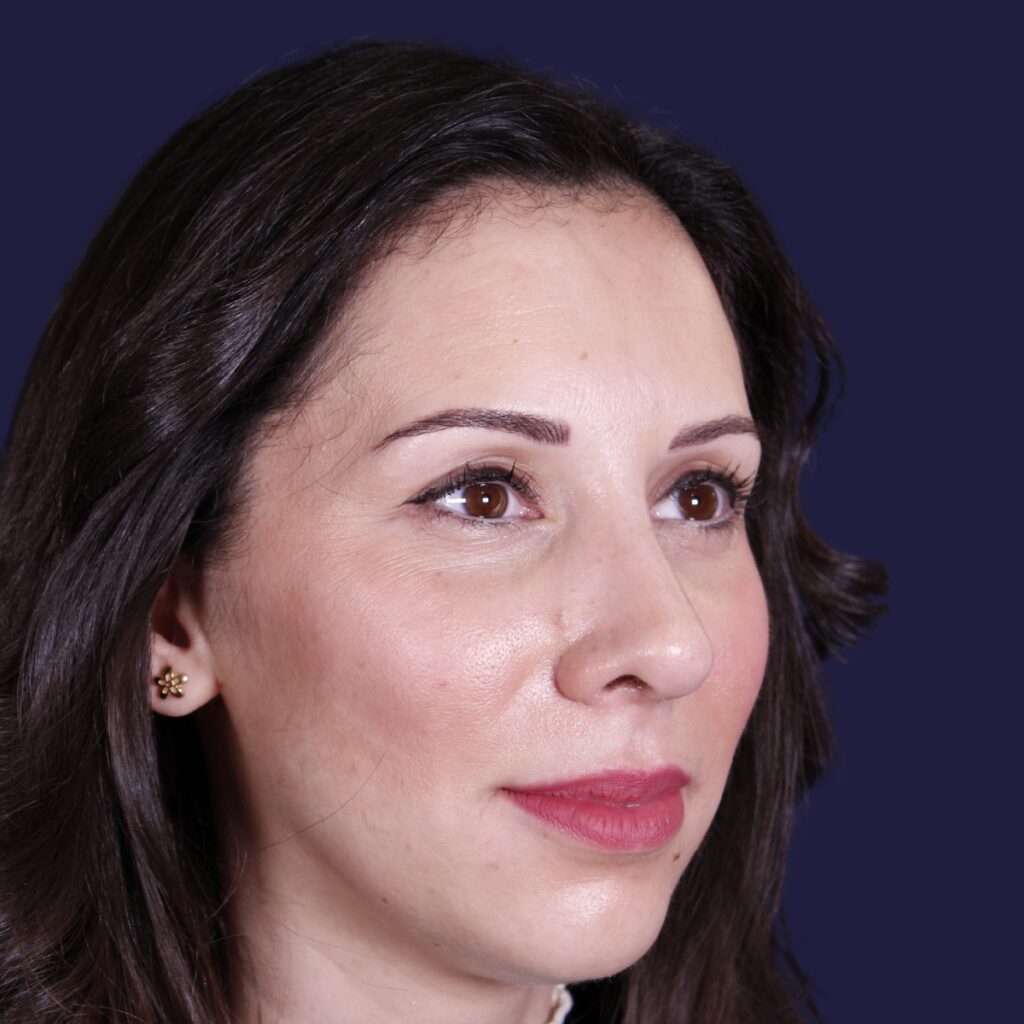 Rhinoplastie ultrasonique, résultat après intervention chirurgicale — cas opéré par le Dr Gustavo Sordo à Madrid (7)