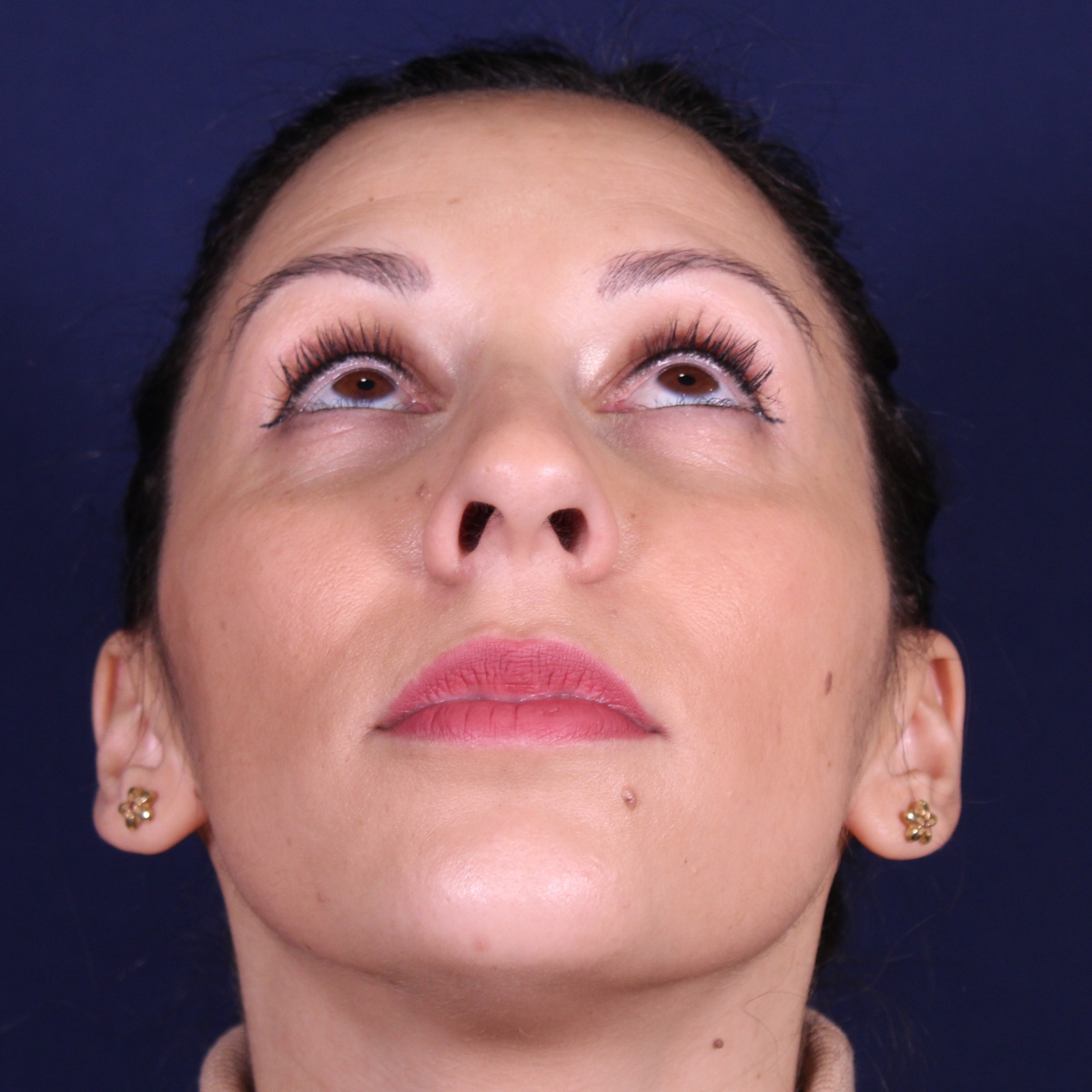 Rhinoplastie ultrasonique, avant l'intervention chirurgicale — cas opéré par le Dr Gustavo Sordo à Madrid (3)