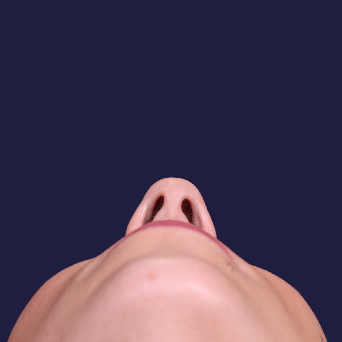 Rhinoplastie ultrasonique, avant l'intervention chirurgicale — cas opéré par le Dr Gustavo Sordo à Madrid (4)