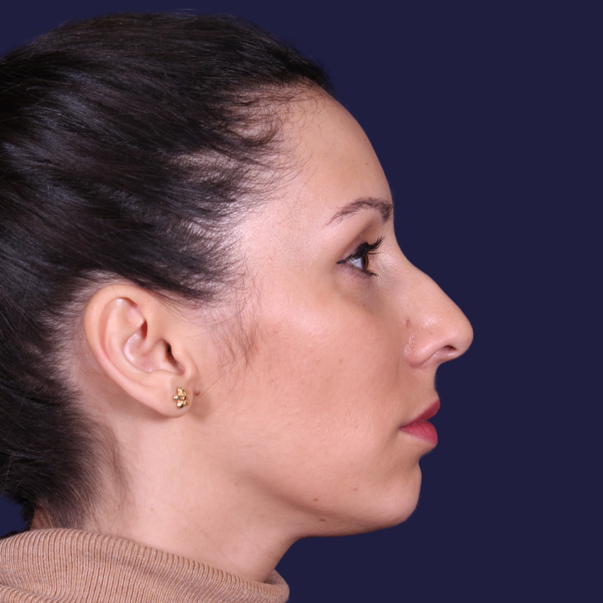 Rhinoplastie ultrasonique, avant l'intervention chirurgicale — cas opéré par le Dr Gustavo Sordo à Madrid (5)