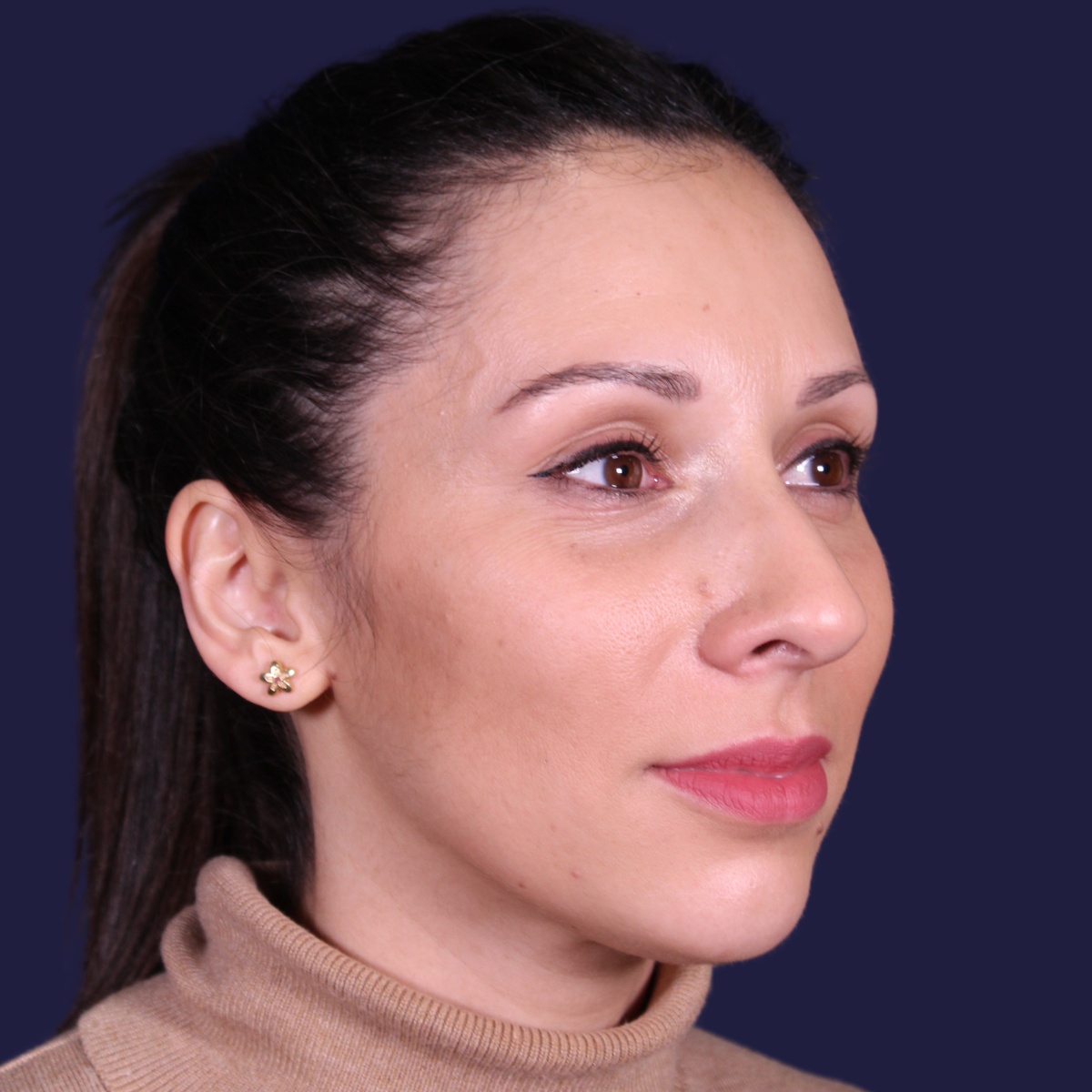 Rhinoplastie ultrasonique, avant l'intervention chirurgicale — cas opéré par le Dr Gustavo Sordo à Madrid (7)