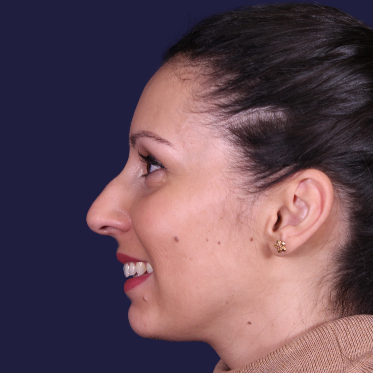 Rhinoplastie ultrasonique, avant l'intervention chirurgicale — cas opéré par le Dr Gustavo Sordo à Madrid (6)