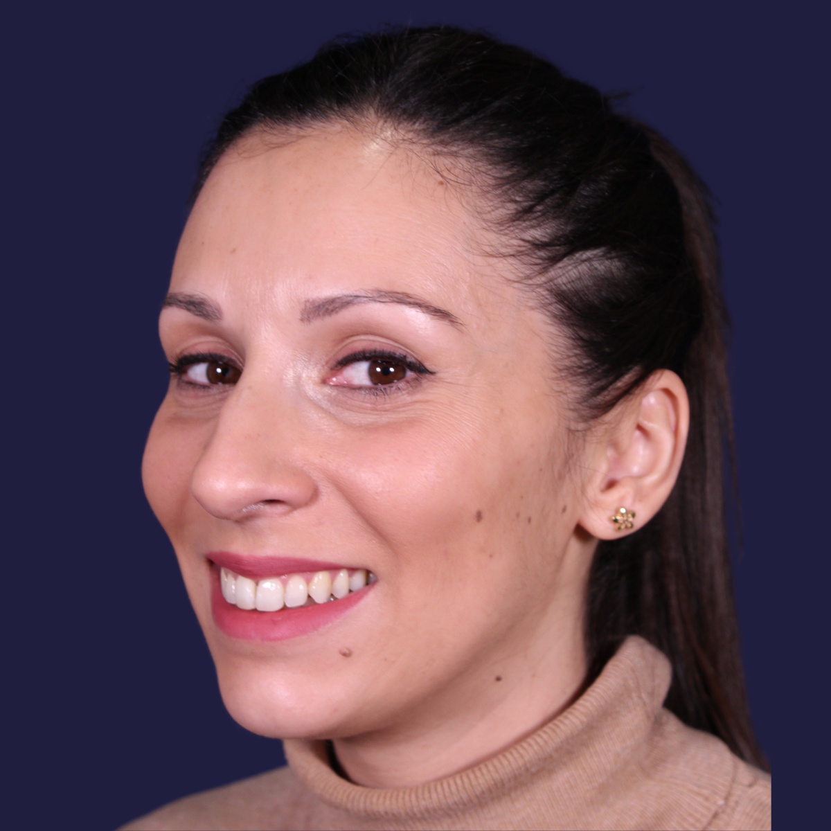 Rhinoplastie ultrasonique, avant l'intervention chirurgicale — cas opéré par le Dr Gustavo Sordo à Madrid (8)